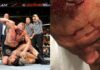 Brock Lesnar Crushes Randy Orton’s Skull By Accident