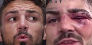 Platinum Perry Reveals BRUTAL Eye Injury After UFC Loss