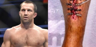 PIC: Luke Rockhold’s Injured Leg Has It’s Own Feeding Tube…