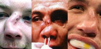Top 10 Nastiest Nose Breaks In MMA History